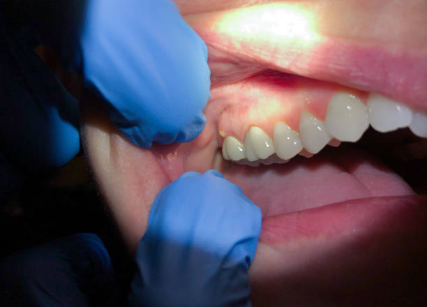 Best Cracked Tooth Emergency Dentist  in Fayetteville, AL
