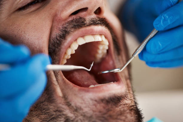 Best Chipped Tooth Repair Near Me  in Fayetteville, AL